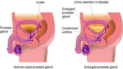 Enlarged Prostate Masturbation 80