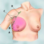 A: Tissue Removed B,C,D: Axillary Lymph Nodes