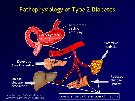 Type 2 Diabetes | Diabetes Education
