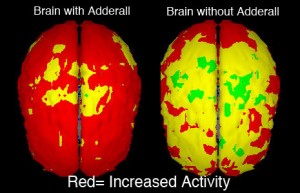 adderall-brain-side-effects1
