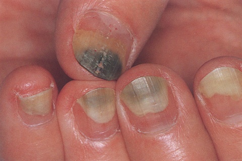 Gel Manicures: Safe or Dangerous? | SiOWfa15: Science in Our World:  Certainty and Controversy