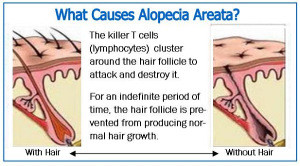 What causes Alopecia Areata ?