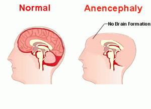anencephaly-1